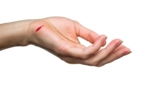 Severe Hand Injury from Knife Wound: Tangan Luka Kena Pisau Parah