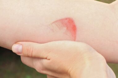 A Burn That is Characterized by Redness and Pain is Classified as a Superficial or First-Degree Burn – Symptoms, Management and Care