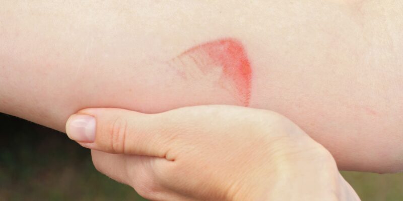 A Burn That is Characterized by Redness and Pain is Classified as a Superficial or First-Degree Burn – Symptoms, Management and Care